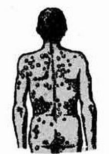 Schéma d'infection possible