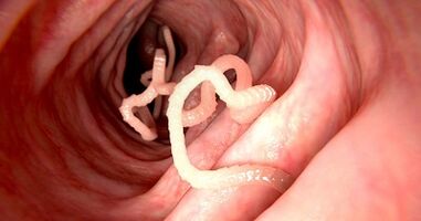 Les causes des parasites dans le corps humain